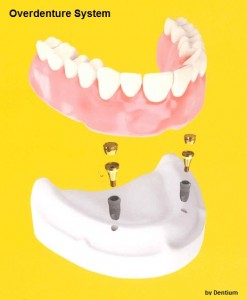 overdenture system