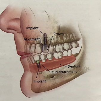 dental implants