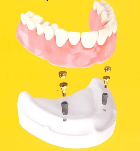 overdenture system