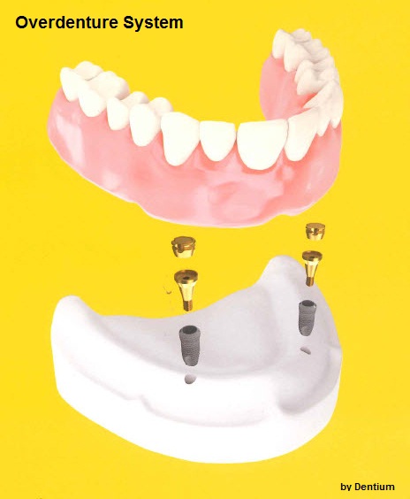 overdenture system