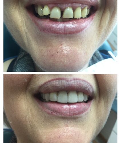veneers before-an dafter