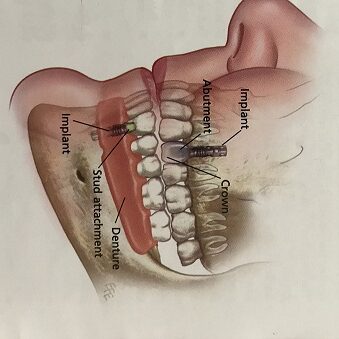 dental implants