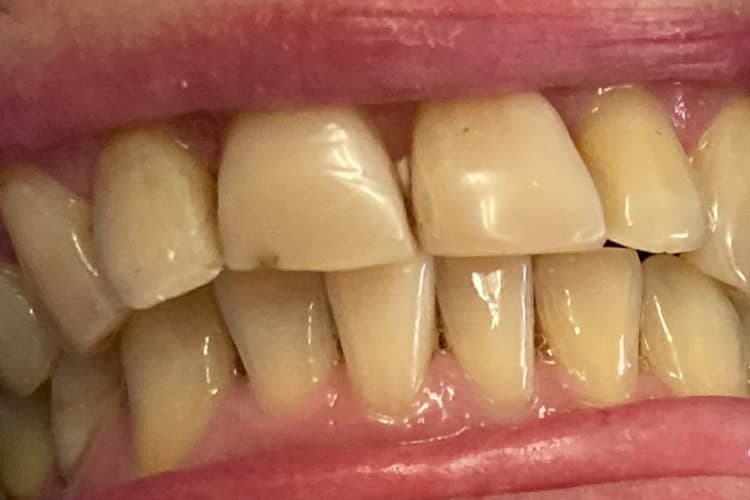 Porcelain veneers and crowns before