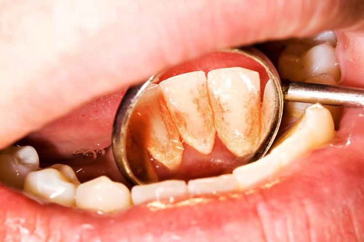 stained-teeth